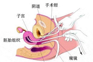 人流手术.jpg